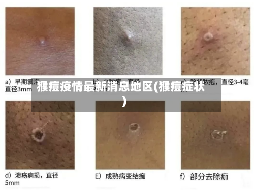 猴痘疫情最新消息地区(猴痘症状)-第3张图片