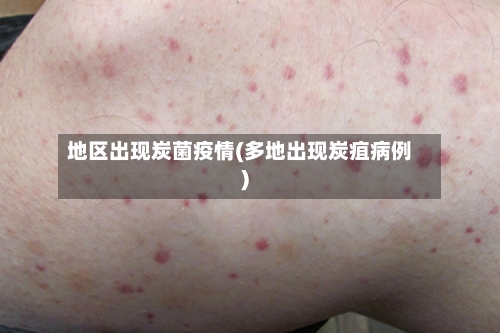 地区出现炭菌疫情(多地出现炭疽病例)-第2张图片